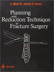 Planning And Reduction Technique In Fracture Surgery 1st Edition By Mast