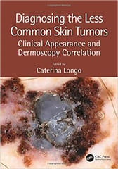 Diagnosing the Less Common Skin Tumors Clinical Appearance and Dermoscopy Correlation 2019 By Longo Publisher Taylor & Francis