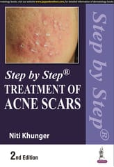 Step by Step Treatment of Acne Scars 2nd Edition 2022 By Niti Khunger