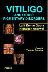 Vitiligo And Other Pigmentary Disorders 1st Edition 2016 By Lalit Gupta