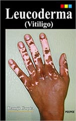 Leucoderma (Vitiligo) 1st Edition 2016 By Ramji Gupta