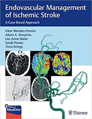 Pereira Endovascular Management of Ischemic Stroke 1st Edition 2021