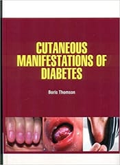 Thomson B Cutaneous Manifestations of Diabetes 1st Edition 2021
