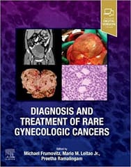 Michael Frumovitz Diagnosis and Treatment of Rare Gynecologic Cancers 2023