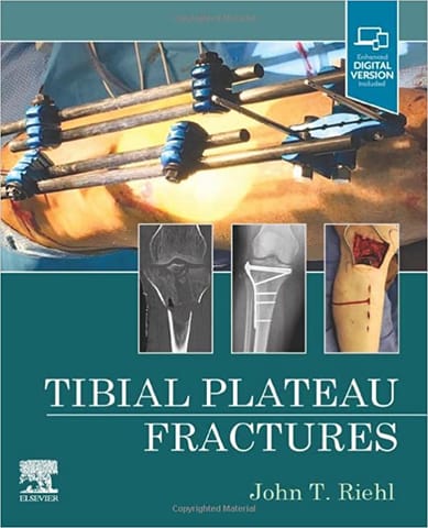Riehl Tibial Plateau Fractures 1st Edition 2022