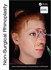 Non Surgical Rhinoplasty 1st edition Dario Bertossi